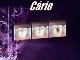 Cárie 