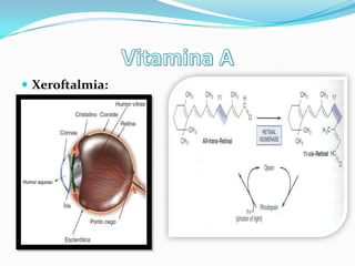  Xeroftalmia:
 
