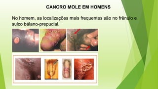CANCRO MOLE EM HOMENS
No homem, as localizações mais frequentes são no frênulo e
sulco bálano-prepucial.
 