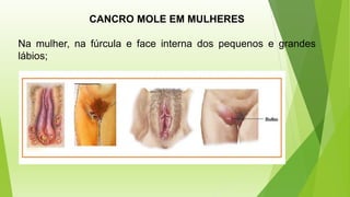 CANCRO MOLE EM MULHERES
Na mulher, na fúrcula e face interna dos pequenos e grandes
lábios;
 