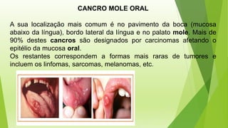 CANCRO MOLE ORAL
A sua localização mais comum é no pavimento da boca (mucosa
abaixo da língua), bordo lateral da língua e no palato mole. Mais de
90% destes cancros são designados por carcinomas afetando o
epitélio da mucosa oral.
Os restantes correspondem a formas mais raras de tumores e
incluem os linfomas, sarcomas, melanomas, etc.
 