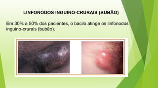 LINFONODOS INGUINO-CRURAIS (BUBÃO)
Em 30% a 50% dos pacientes, o bacilo atinge os linfonodos
inguino-crurais (bubão).
 