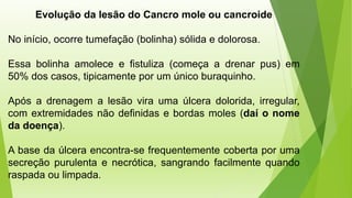 Evolução da lesão do Cancro mole ou cancroide
No início, ocorre tumefação (bolinha) sólida e dolorosa.
Essa bolinha amolece e fistuliza (começa a drenar pus) em
50% dos casos, tipicamente por um único buraquinho.
Após a drenagem a lesão vira uma úlcera dolorida, irregular,
com extremidades não definidas e bordas moles (daí o nome
da doença).
A base da úlcera encontra-se frequentemente coberta por uma
secreção purulenta e necrótica, sangrando facilmente quando
raspada ou limpada.
 