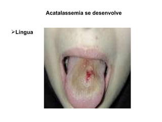 Acatalassemia se desenvolve Língua 