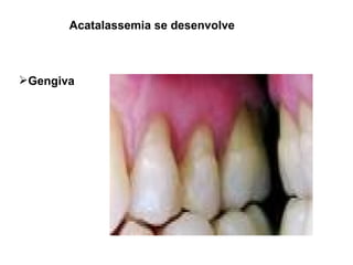 Acatalassemia se desenvolve Gengiva 