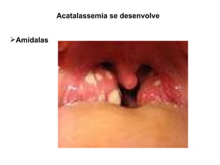 Acatalassemia se desenvolve Amídalas 