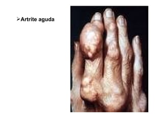 Artrite aguda 