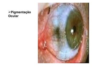 Pigmentação Ocular 