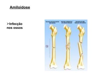 Amiloidose Infecção nos ossos 