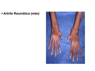 Artrite Reumática (mão) 