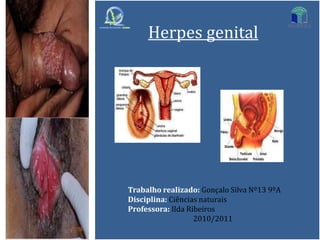 Herpes genital Trabalho realizado: Gonçalo Silva Nº13 9ºA Disciplina: Ciências naturais  Professora: Ilda Ribeiros 2010/2011 