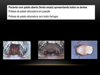 Paciente com palato aberto (fenda ampla) apresentando todos os dentes
Prótese de palato obturadora em posição
Prótese de palato obturadora com bulbo faríngeo
 