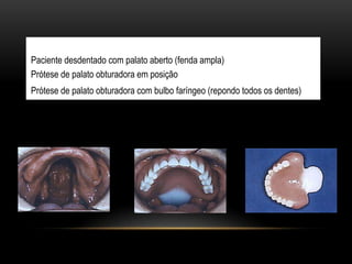 Paciente desdentado com palato aberto (fenda ampla)
Prótese de palato obturadora em posição
Prótese de palato obturadora com bulbo faríngeo (repondo todos os dentes)
 