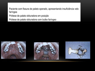 Paciente com fissura de palato operado, apresentando insuficiência velo
faríngea
Prótese de palato obturadora em posição
Prótese de palato obturadora com bulbo faríngeo
 
