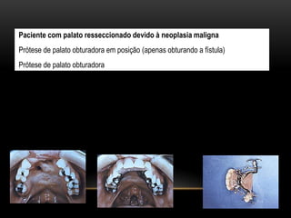 Paciente com palato resseccionado devido à neoplasia maligna
Prótese de palato obturadora em posição (apenas obturando a fístula)
Prótese de palato obturadora
 