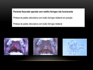 Paciente fissurado operado com retalho faríngeo não funcionante
Prótese de palato obturadora com bulbo faríngeo bilateral em posição
Prótese de palato obturadora com bulbo faríngeo bilateral
 