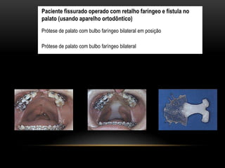 Paciente fissurado operado com retalho faríngeo e fístula no
palato (usando aparelho ortodôntico)
Prótese de palato com bulbo faríngeo bilateral em posição
Prótese de palato com bulbo faríngeo bilateral
 