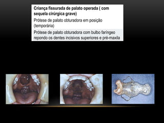 Criança fissurada de palato operada ( com
sequela cirúrgica grave)
Prótese de palato obturadora em posição
(temporária)
Prótese de palato obturadora com bulbo faríngeo
repondo os dentes incisivos superiores e pré-maxila
 