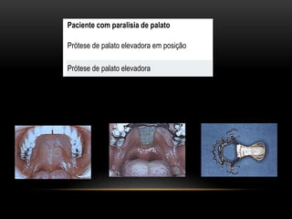 Paciente com paralisia de palato

Prótese de palato elevadora em posição

Prótese de palato elevadora
 
