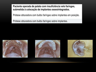 Paciente operada de palato com insuficiência velo faríngea,
submetida à colocação de implantes osseointegrados.

Prótese obturadora com bulbo faríngeo sobre implantes em posição.

Prótese obturadora com bulbo faríngeo sobre implantes.
 