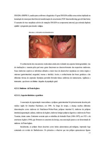 20
SMAD4e BMPR1A,usadosparaconfirmarodiagnóstico.O geneSMAD4codifica umaenzima implicada na
transduçãodesinaispara fatorbetadetransformaçãodocrescimento(TGF-beta-tranforming growthfatorbeta).
O aumento do risco neoplásico advém de mutações SMAD4 no componente estromal, que estimula displasia
epitelial eprogressão para invasão maligna.
O conhecimentodos mecanismos molecularesaindaestáevoluindo nosaspectos heterogeneidade, vias
de sinalizações e maneira pela qual esses genes funcionam no desenvolvimento das respectivas síndromes.
Essas síndromes expõem os indivíduos afetados a maior risco de desenvolver neoplasias em vários órgãos e
sistemas (gastrointestinal, urogenital, mamas e tireóide). Assim, o conhecimento das bases genéticas e das
diferentes formas de expressão fenotípica permitirá formular táticas uniformes de rastreamento, vigilância e
tratamento, quedevem serdistintas daquelas dapopulação geral.
4.2.1.1.Síndrome dePeutz-Jeghers
4.2.1.1.1.Aspectoshistóricos egenéticos
A associação de pigmentação mucocutânea e polipose gastrointestinal foiprimeiramente descrita pelo
médico inglês Sir Jonathan Huchinson, em 1896. Ao longo do tempo, a doença recebeu diferentes
denominações como síndrome de Hutchinson-Weber-Peutz, polipose intestinal II, síndrome da polipose
intestinal-pigmentação cutânea, síndrome deJeghers,síndrome lentigio-poliposedigestivae síndromede Peutz-
Touraine, dentre outras. Entretanto somente após os trabalhos do holandês Peutz (1886-1897), em 1921 e do
americano Jeghers (1944), que firmaramos caracteres da doença, essa associação passoua ser denominada de
síndrome dePeutz-Jeghers.
Inicialmente, os pólipos foram descritos como lesões adenomatosa pré-malignas, impressão logo
contestada em revisão de Bartholomew. Os primeiros a observar que tais pólipos apresentavam figuras
FIGURA 1: PÓLIPOS HAMARTOSOS
 