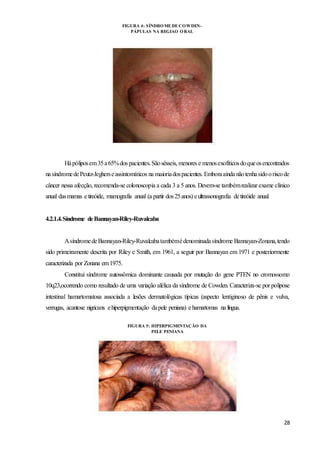 28
Hápóliposem35a65%dos pacientes.Sãosésseis, menores e menosexofíticosdoqueosencontrados
nasíndromedePeutz-Jegherseassintomáticos na maioriadospacientes. Emboraainda nãotenhasidooriscode
câncer nessa afecção, recomenda-se colonoscopia a cada 3 a 5 anos. Devem-se tambémrealizar exame clinico
anual dasmamas etireóide, mamografia anual (a partir dos25anos) eultrassonografia detireóide anual.
4.2.1.4.Síndrome deBannayan-Riley-Ruvalcaba
AsíndromedeBannayan-Riley-Ruvalcabatambémédenominadasíndrome Bannayan-Zonana,tendo
sido primeiramente descrita por Riley e Smith, em 1961, a seguir por Bannayan em 1971 e posteriormente
caracterizada por Zonana em1975.
Constitui síndrome autossômica dominante causada por mutação do gene PTEN no cromossomo
10q23,ocorrendo como resultado de uma variação alélica da síndrome de Cowden. Caracteriza-se por polipose
intestinal hamartomatosa associada a lesões dermatológicas típicas (aspecto lentiginoso de pênis e vulva,
verrugas, acantose nigricans ehiperpigmentação dapele peniana) ehamartomas na língua.
FIGURA 4: SÍNDROMEDECOWDEN-
PÁPULAS NA REGIAO ORAL
FIGURA 5: HIPERPIGMENTAÇÃO DA
PELE PENIANA
 