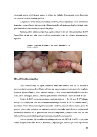 22
ocasionando anemia, principalmente quando os pólipos são múltiplos. Eventualmente ocorre hemorragia
maciça,quesemanifestaemváriosepisódios.
Odiagnóstico ésimples desdequeseconheça asíndrome, sendo a pigmentação com as características
já descritas o elemento básico. A comprovação é feita pelos estudos radiológicos e endoscópico de todo o trato
gastrointestinal,bemcomoaanálisedanaturezadospólipos.
Raramente pólipos solitários do tipo Peutz Jeghers se desenvolvem sem outras características da SPJ.
Esses pólipos não são associados a risco de câncer gastrointestinal e não são indicação para rastreamento
especifico.
4.2.1.1.3.Potencialdemalignidade
Desde o clássico artigo de Jeghers, numerosos autores tem reportado casos de SPJ associada a
carcinoma digestivo, acumulando evidências suficientes que sugerem maior risco para desenvolver neoplasias
do sistema digestivo (duodeno, jejuno, pâncreas, estômago e cólon) ou extra intestinais (pulmões, testículos,
ovário,cérvix,tireóide,pele,mamas).Ostumoresgastrointestinaiscorrespondemamenosdametadedototal.
Dozois et al. (1969) encontraram carcinoma s gastrointestinais em 11 dos 326 casos de SPJ relatados
até a época, que corresponde a um índice de transformação maligna da ordem de 2 a 3%. Konishi et al.(1987)
encontraram 50 casos de carcinomas digestivos associados à síndrome, sendo 20 deles no intestino grosso. Ao
longo do tempo muitos carcinomas em pacientes jovens foram reportados, sugerindo que o carcinoma está
relacionado à síndrome e não se apresenta como uma lesão independente, ocorrendo muitas vezes em faixa
etáriamaisbaixaquenapopulaçãogerale,principalmente,empulmões,mamasecólon.
Hoje se aceita que o risco cumulativo de carcinoma colorretal seja (CCR) de 10 a 20% e o risco para
tumores malignos se situe entre 20 e 50%. Em relação à população geral, estima-se que o risco seja 18 vezes
FIGURA 2: PIGMENTAÇÃO CARACTERÍSTICA DA SÍNDROMEPJ EM
DEDOS E LÁBIOS
 
