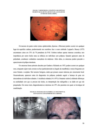36
Os tumores de partes moles (cistos epidermóides, lipomas e fibromas) podem ocorrer em qualquer
lugar da superfície cutânea, predominando nos membros, face e couro cabeludo. Leppard e Bussey (1975)
encontraram cistos em 53% de 70 portadores de PAF. Embora tenham apenas interesse cosmético, tem
importância por serem lesões raras na infância em indivíduos sem polipose. Quando aparecem antes da
puberdade, constituem verdadeiros marcadores da síndrome. Além deles, os osteomas podem preceder o
aparecimentodepóliposintestinais.
Os osteomas foram primeiro descritos por Gardner e Richards em 1953, podem ocorrer em qualquer
osso, conquanto sejam mais comuns naface(particularmenteno ângulo da mandíbula) e menos frequentes em
ossos frontais e occiptais. São tumores benignos, ainda que possam causar sintomas por crescimento local.
Ocasionalmente, aparecem antes do diagnostico da polipose, podendo sugerir a herança do gene em
descendentes de indivíduos afetados. A incidência relatada (14 a 93%) é bastante variável, refletindo diferenças
na assiduidade com que se procura tais lesões, na interpretação das radiografias e na idade em que são
pesquisadas. Em nosso meio, diagnosticaram-se osteomas em 25% dos pacientes nos quais se investigou tal
manifestação.
FIGURA 8: OSTEOMAS DE MANDÍBULA E OSSO FRONTAL
EM PACIENTE COM SINDROME DE GARDNER.
FIGURA 7: HIPERTROFIA CONGÊNITA DO EPITÉLIO
PIGMENTAR DA RETINA DETECTADA AO EXAME DE
FUNDO DE OLHO (CHRPE)
 