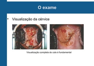 O exame

Visualização da cérvice
Visualização completa do colo é fundamental
 