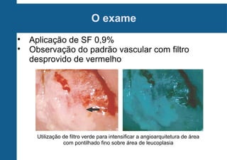 O exame

Aplicação de SF 0,9%

Observação do padrão vascular com filtro
desprovido de vermelho
Utilização de filtro verde para intensificar a angioarquitetura de área
com pontilhado fino sobre área de leucoplasia
 