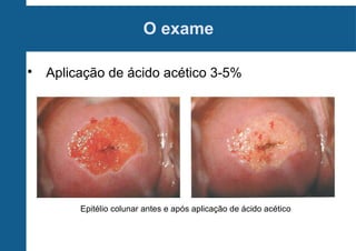 O exame

Aplicação de ácido acético 3-5%
Epitélio colunar antes e após aplicação de ácido acético
 