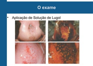 O exame

Aplicação de Solução de Lugol
 