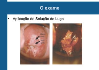 O exame

Aplicação de Solução de Lugol
 