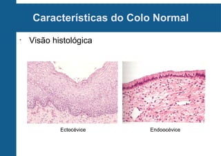 Características do Colo Normal
•
Visão histológica
Ectocévice Endoocévice
 