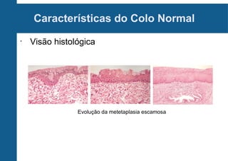 Características do Colo Normal
•
Visão histológica
Evolução da metetaplasia escamosa
 