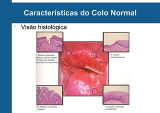 Características do Colo Normal
•
Visão histológica
 