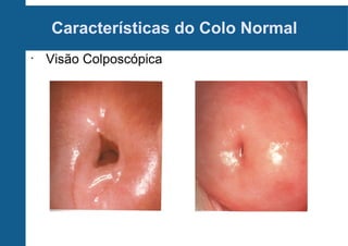 Características do Colo Normal
•
Visão Colposcópica
 
