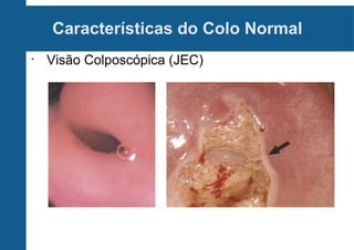 Características do Colo Normal
•
Visão Colposcópica (JEC)
 