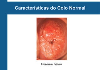 Características do Colo Normal
Ectrópio ou Ectopia
 