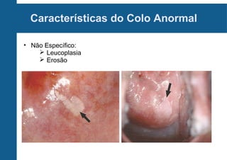 Características do Colo Anormal
• Não Específico:
 Leucoplasia
 Erosão
 