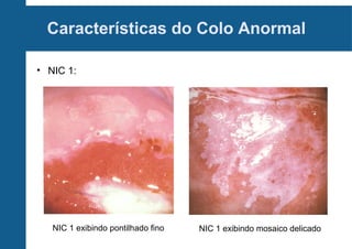 Características do Colo Anormal
• NIC 1:
NIC 1 exibindo pontilhado fino NIC 1 exibindo mosaico delicado
 