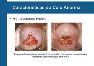 Características do Colo Anormal
• NIC 1 x Metaplasia Imatura:
Imagens de metaplasia imatura (comprovada com bióspia) que poderiam
facilmente ser confundidas com NIC1
 