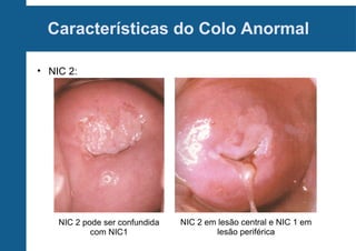 Características do Colo Anormal
• NIC 2:
NIC 2 pode ser confundida
com NIC1
NIC 2 em lesão central e NIC 1 em
lesão periférica
 