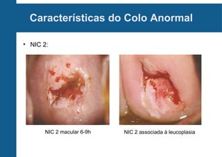Características do Colo Anormal
• NIC 2:
NIC 2 macular 6-9h NIC 2 associada à leucoplasia
 