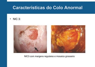 Características do Colo Anormal
• NIC 3:
NIC3 com margens regulares e mosaico grosseiro
 