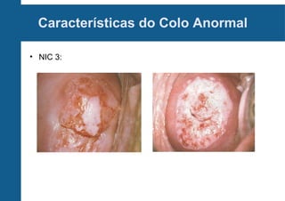 Características do Colo Anormal
• NIC 3:
 