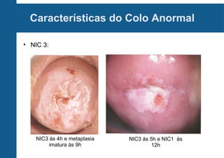 Características do Colo Anormal
• NIC 3:
NIC3 às 4h e metaplasia
imatura às 9h
NIC3 às 5h e NIC1 às
12h
 