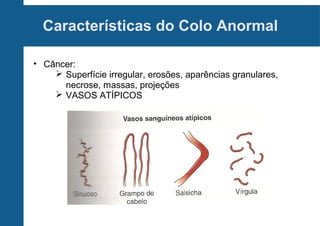 Características do Colo Anormal
• Câncer:
 Superfície irregular, erosões, aparências granulares,
necrose, massas, projeções
 VASOS ATÍPICOS
 