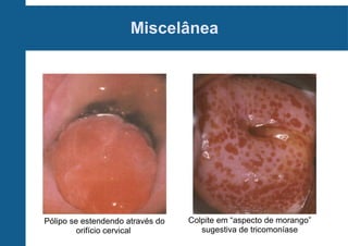 Miscelânea
Pólipo se estendendo através do
orifício cervical
Colpite em “aspecto de morango”
sugestiva de tricomoníase
 