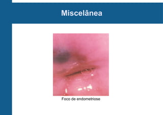 Miscelânea
Foco de endometriose
 